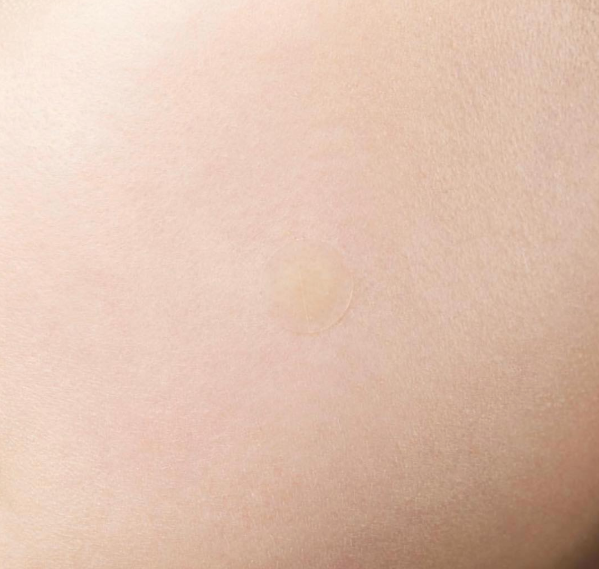 Parches de hidrocoloide para acné que protegen, absorben el sebo y aceleran la cicatrización de granitos, incluye 24 parches de distintos tamaños.