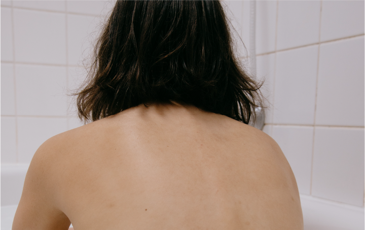 Acné Corporal (Bacné): Qué Es y Cómo Tratarlo